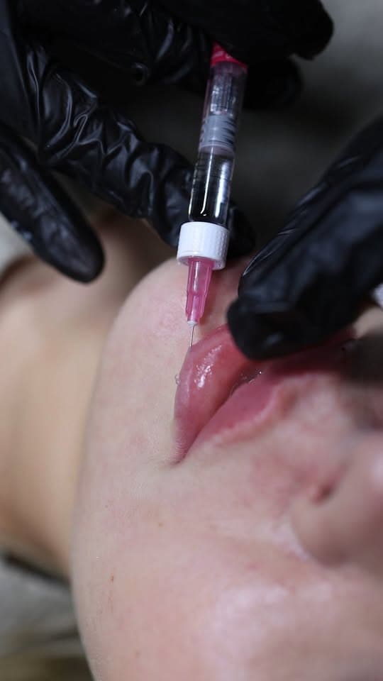 Russian lip filler 0.5ML