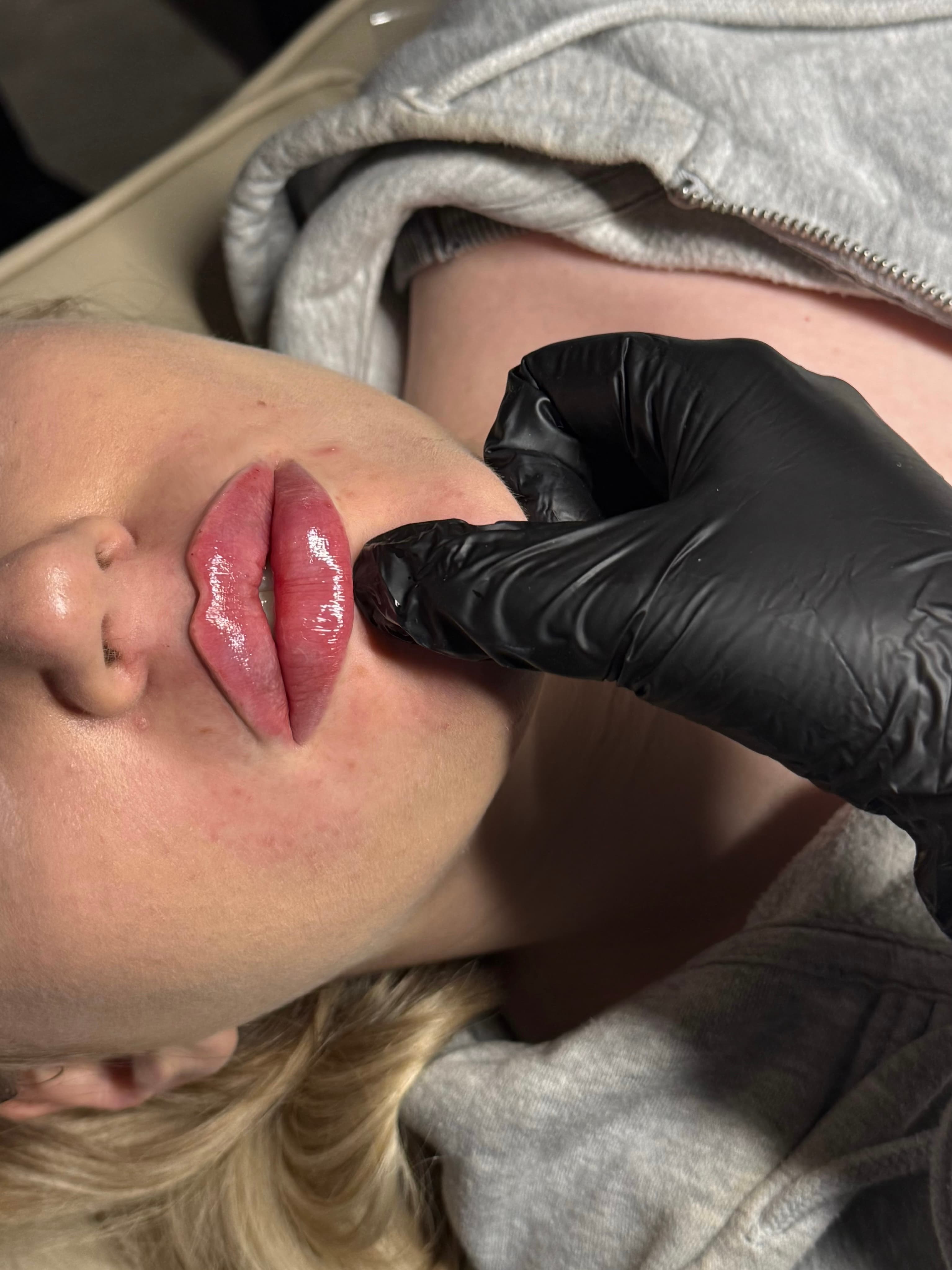 Lip filler 1.1ML