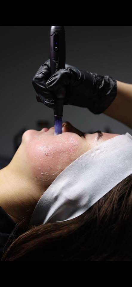 Microneedling